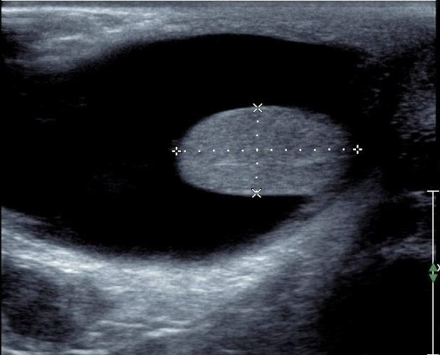 <p>Hydrocele</p>