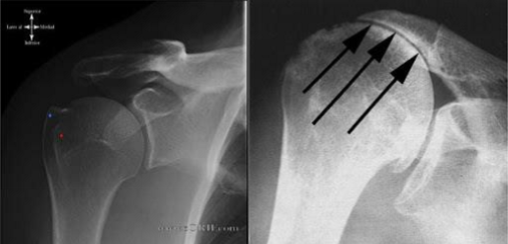 <p>a condition where the rotator cuff tendons become irritated and inflamed due to compression during shoulder movement</p>