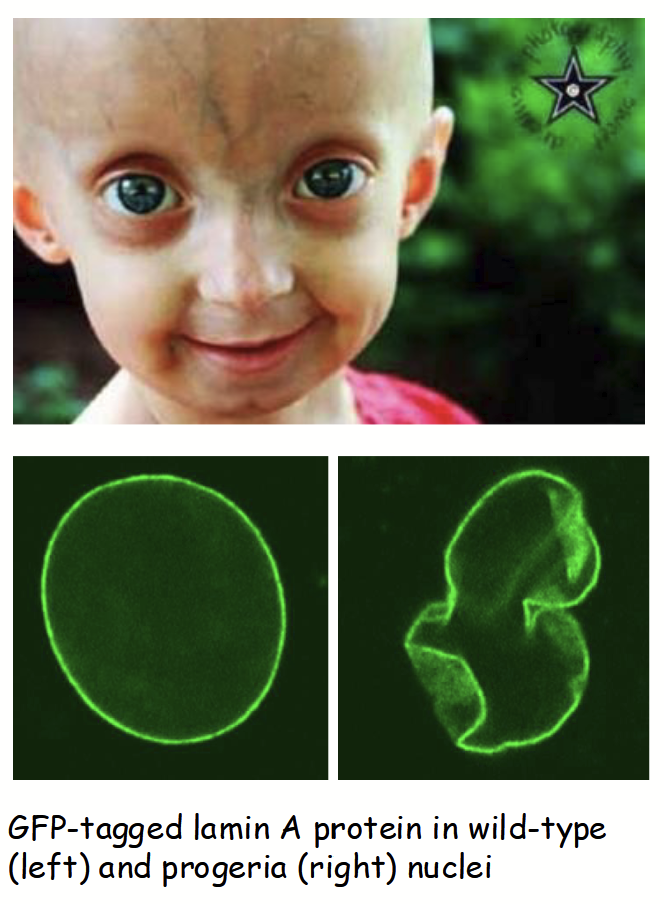 <p>Mutations in LAMIN genes responsible for several human diseases.</p><p>e.g. Hutchinson-Gilford Progeria Syndrome</p><ul><li><p>Rare, characterized by premature aging in children (e.g. hair loss, wrinkles, artery damages) - death by early adolescence</p></li><li><p>Due to a point mutation (sproadic - occurs in embryo development) in LAMIN A gene leading to truncated lamin protein</p></li><li><p>Results in destabilization/breakdown of nuclear lamina, causes aberrant changes in nuclear (envelope) morphology and function</p></li><li><p>Recently: promising advances using CRISPR/Cas9 genome editing-based (gene) therapy in mice</p></li></ul><p></p>