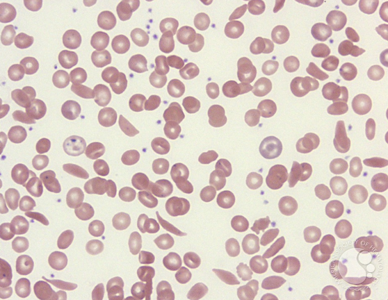 <p>what disease/condition is associated with increased codocytes and sickle cells?</p>