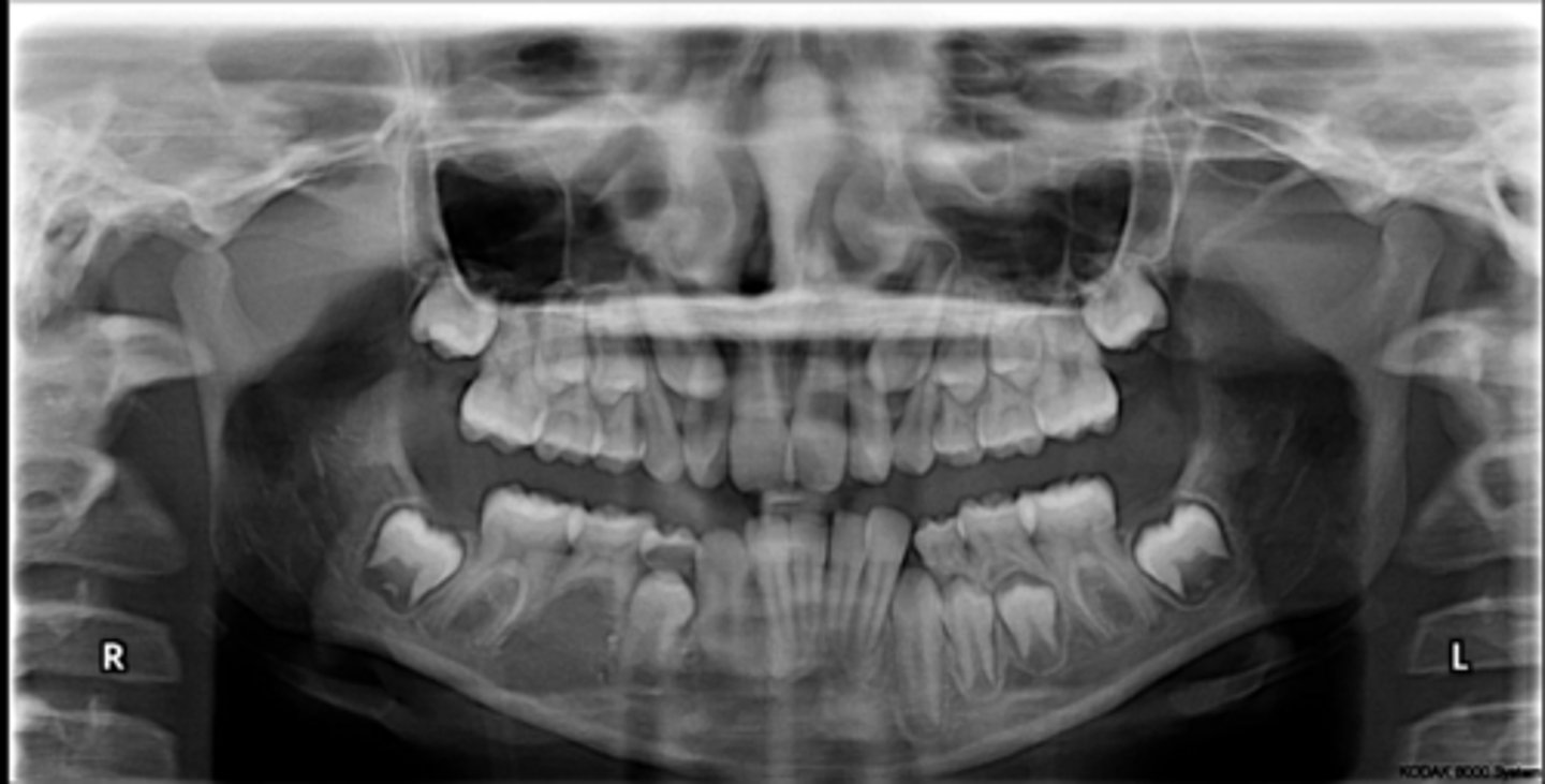 <p>Are there any ankylosed primary teeth?</p>