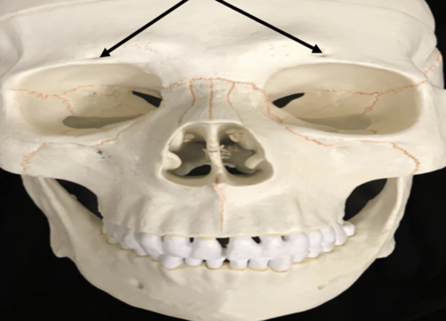 <p>supraorbital notch</p>