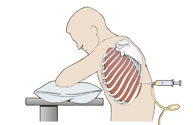 <p>Removal of fluid in chest</p>