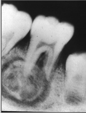 <ul><li><p>Radiopaque mass that is fused to one or more tooth roots</p></li><li><p>Outline of the root or roots is usually obscured</p></li><li><p>Surrounded by a thin radiolucent rim</p></li></ul><p></p>