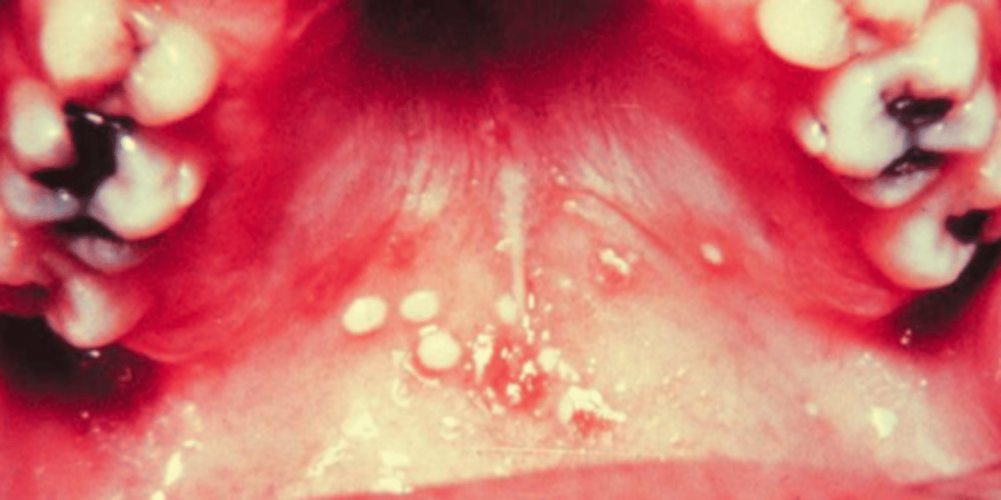 <p>herpangina; non-keratinized tissue only</p>