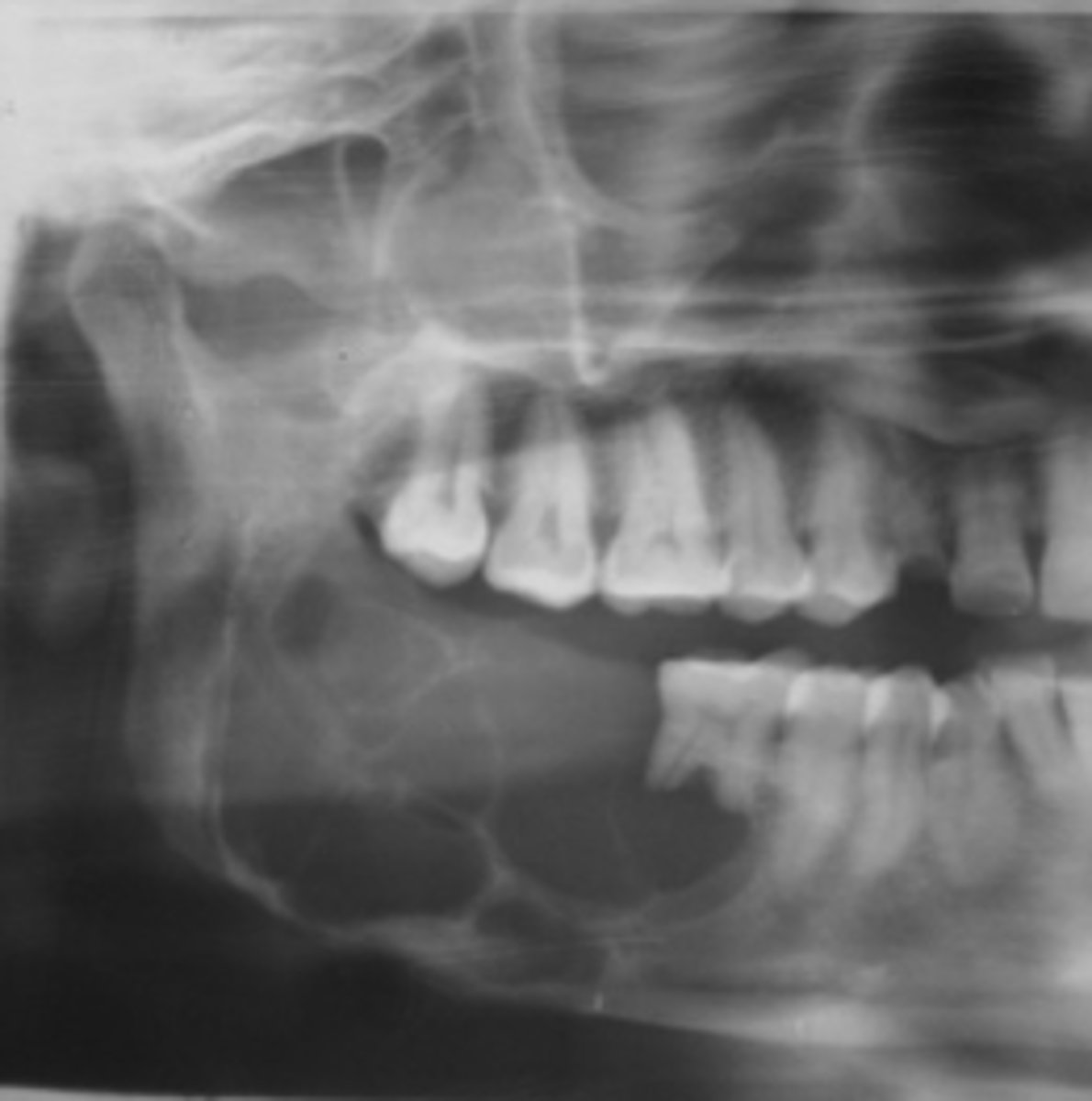 <p>40 y/o patient presents with a well defined, corticated, multi-locular with thick/coarse curved septae lesion on the posterior mandible. Thinning and expansion of the border of the mandible is evident and it displaces the IAN inferiorly. The roots of tooth #30 are resorbed. The lesion is VERY expansile. What is the diagnosis?</p>