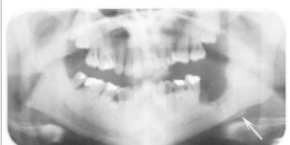 <p>Complex odontoma </p>