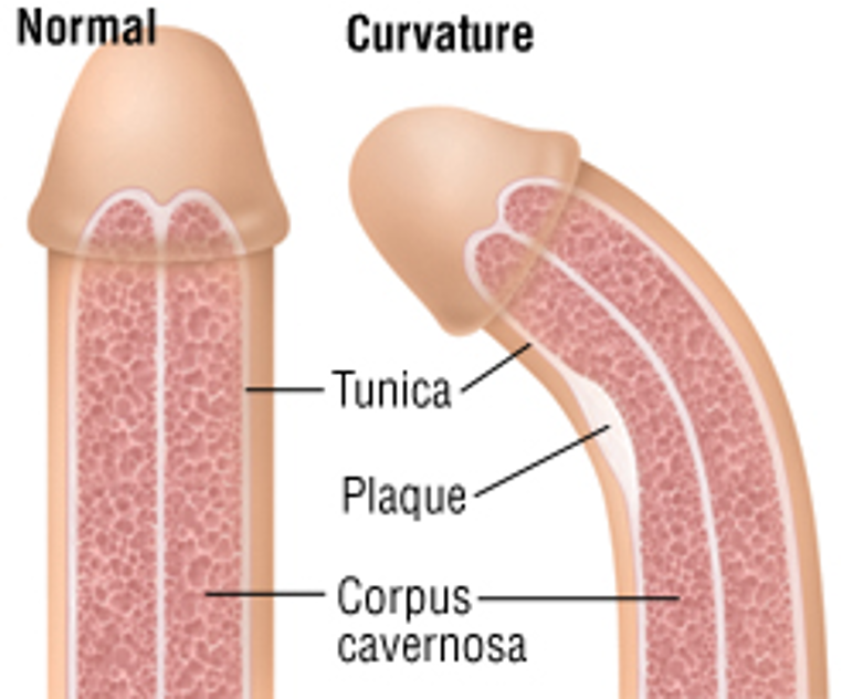 <p>What does this refer to </p><ul><li><p>Slow development of fibrous plaques (thickening) in the tunica albuginea, causing lateral curvature of penis during erection</p></li><li><p>Occurs in middle-aged men and causes painful erections and intercourse</p></li></ul><p></p>