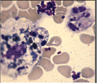 <p>The predominant cells seen on the CSF smear are indicative of:</p><p>Normal cytocentrifuged smear</p><p>Viral meningitis</p><p>Bacterial meningitis</p><p>Fungal infection</p>