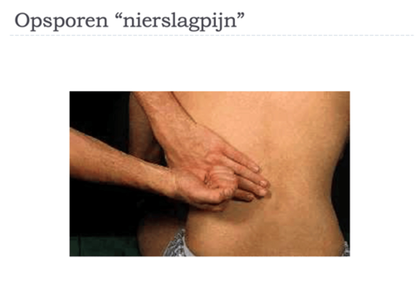 <p>Welk teken tijdens klinisch onderzoek wijst sterk in de richting van nierkoliek?</p>