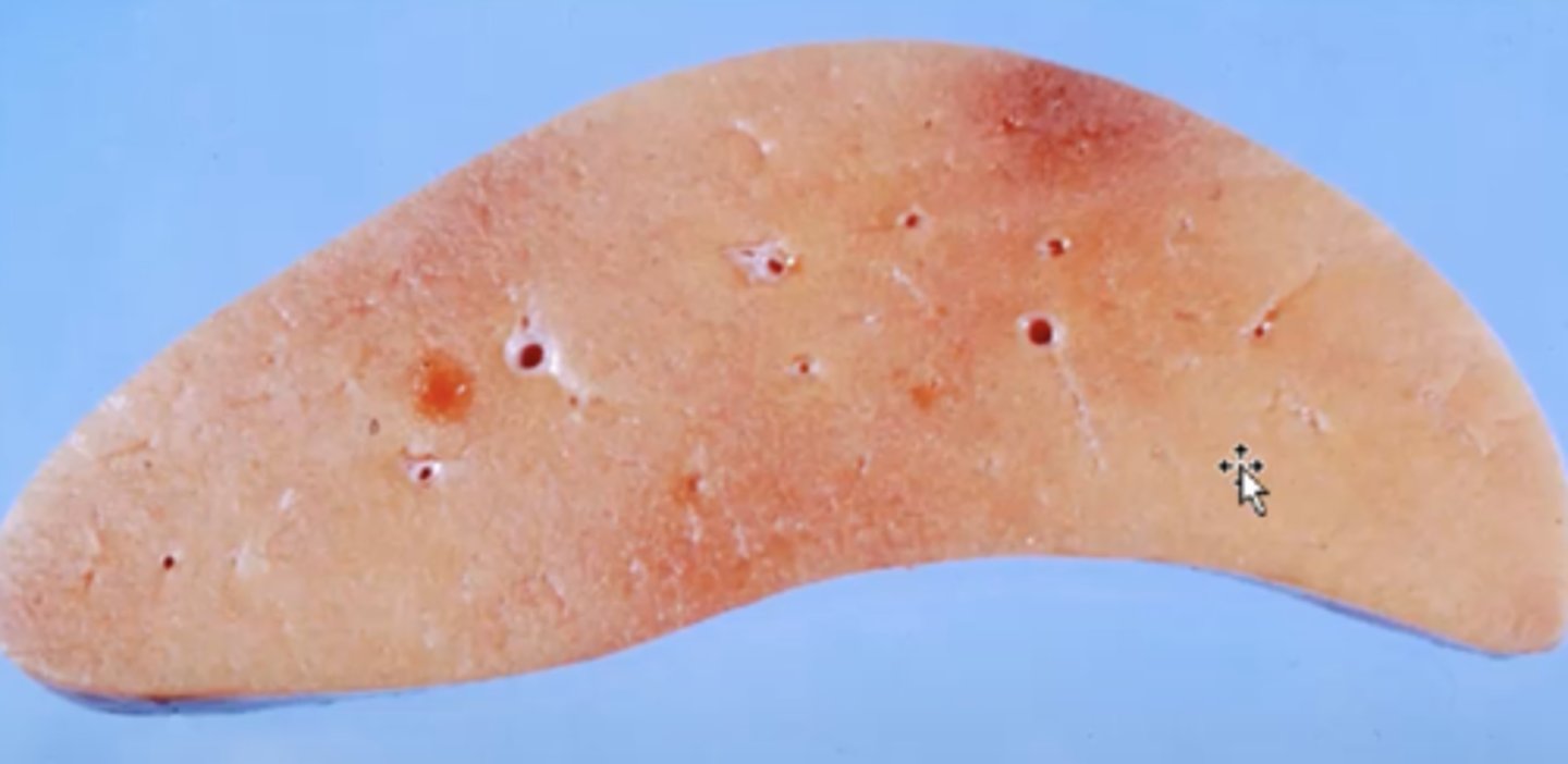 <p>What has caused this gross appearance of this liver?</p>