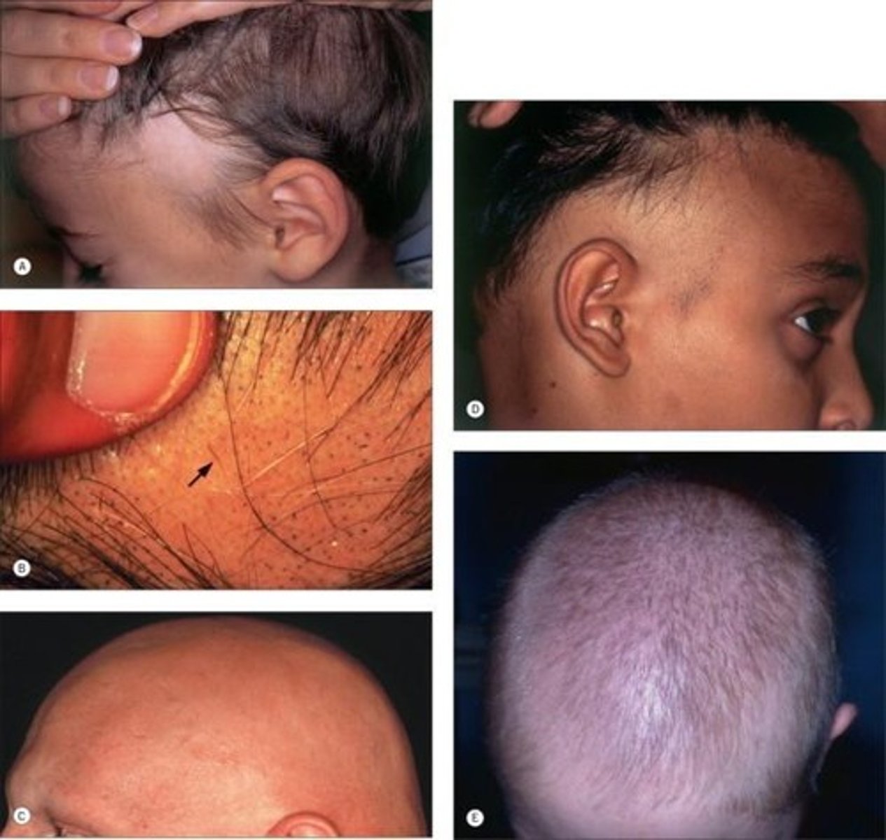 <p>Reassurance</p><p>- will resolve with end of chemotherapy</p><p>- hair may grow back a different color or texture</p>