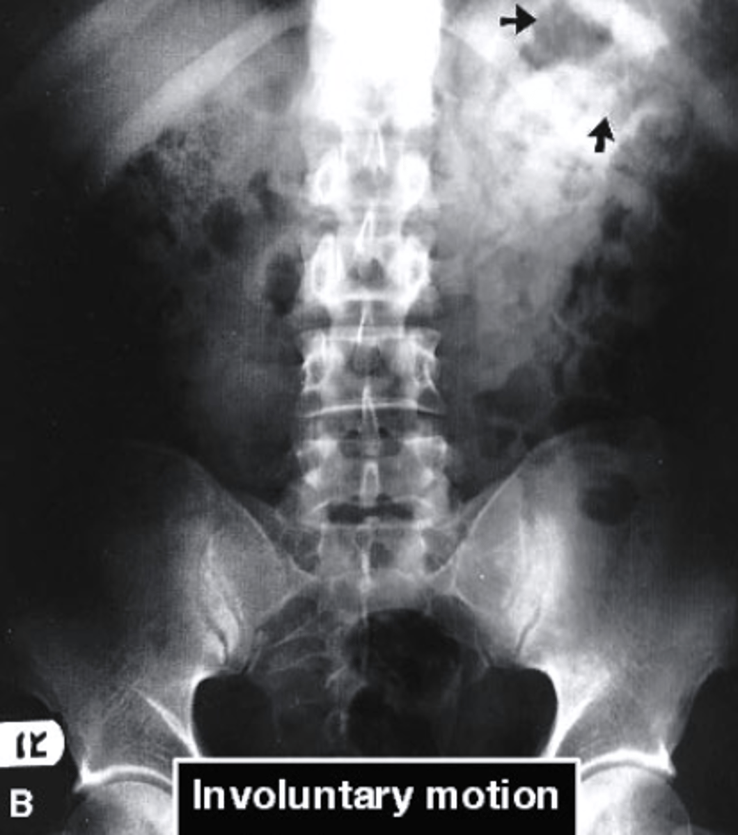 <p>Motion was discussed to affect the ______ of an image</p><p>a. recorded distortion</p><p>b. radiographic density</p><p>c. recorded detail</p><p>d. radiographic contrast</p>