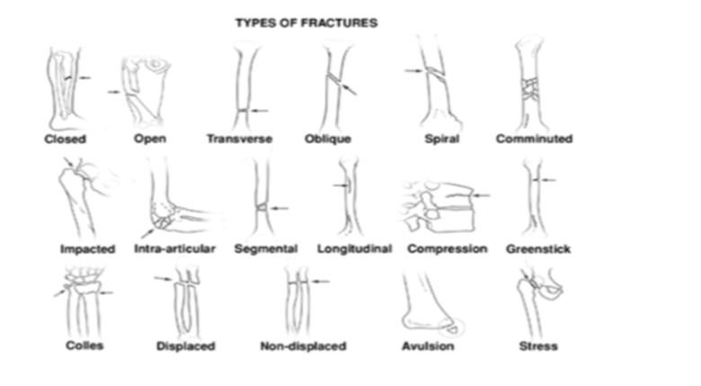 <p>types of fractures (matching section)</p>