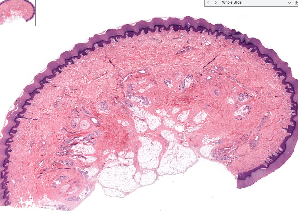 contains collagen fibers arranged into irregular, interwoven bundles.