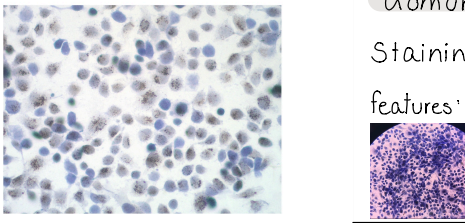 <p>Acid phosphatase</p><p>Gomorri’s reaction</p><p>staining : hematoxylin</p><p>features : black-browish granules equal in size, spread through whole cell but focuses on nucleus, blue nucleus</p>