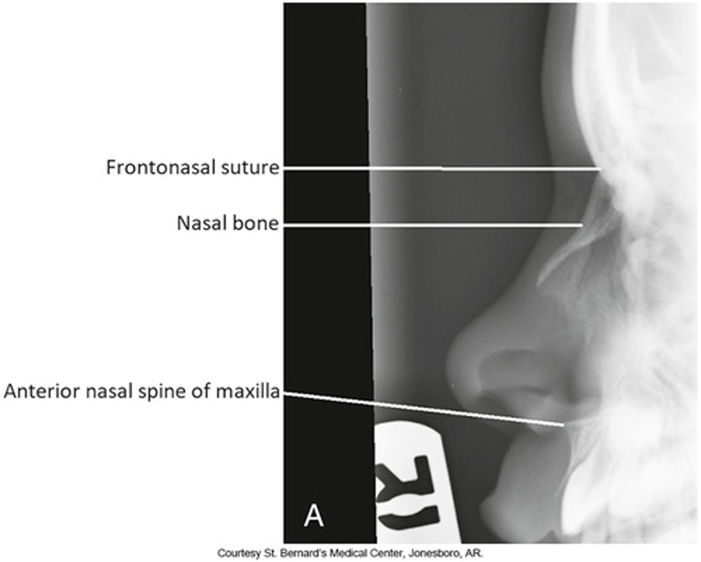 <p>What is this projection?</p><p>How is Patient positing?</p><p>What is the CR?</p><p>What are the structures shown?</p>