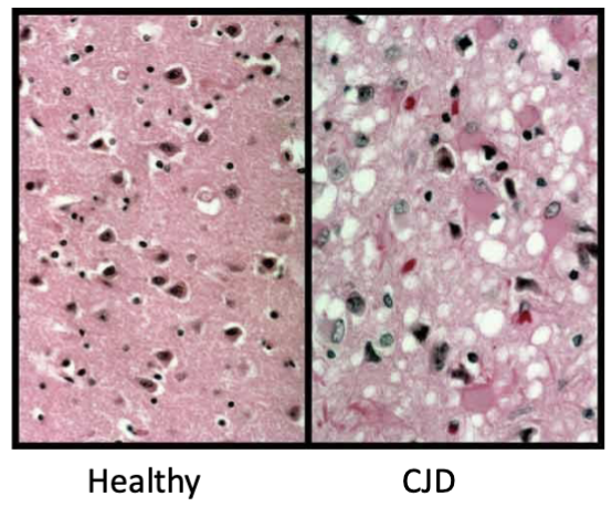 <p><strong>what</strong>: most common prion disease</p><p><strong>organism</strong>: humans</p><ul><li><p><strong>route of infection</strong>:</p><ul><li><p>sporadic/idiopathic</p></li><li><p>genetic predisposition</p></li><li><p>eating beef with mad cow disease (<strong>vCJD</strong>: 20-30 y/o’s, 8-38 month survivial)</p></li><li><p><mark data-color="yellow" style="background-color: yellow; color: inherit">iatrogenic (hospital acquired via brain surgery tools)</mark></p></li></ul><p><strong><mark data-color="yellow" style="background-color: yellow; color: inherit">discovery</mark></strong><mark data-color="yellow" style="background-color: yellow; color: inherit">: 1920, Austria</mark></p><p><strong>symptoms</strong>:</p><ul><li><p><em>classical</em>: dementia</p></li><li><p><em>variant</em>: pyschological</p></li><li><p><em>both</em>: anxiety/depression, dementia, ataxia, coma</p></li></ul><p><strong>survival: </strong>4 months</p></li></ul><p></p>