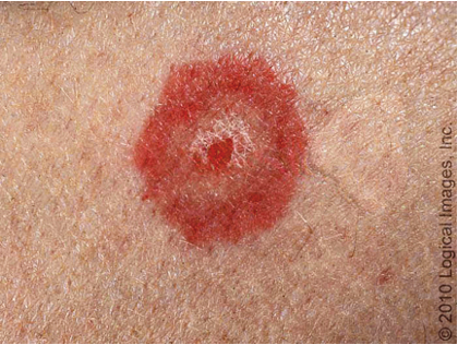 <p>acute, immune mediated condition characterized by distinctive target like lesions on skin </p>