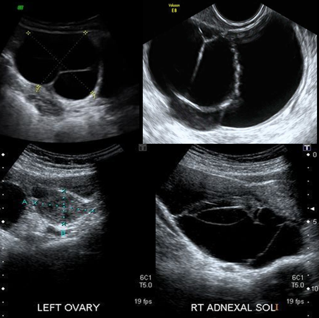 <p>Serous cystadenoma is the _____ most common benign tumor of the ovary. Commonly seen in ______</p>