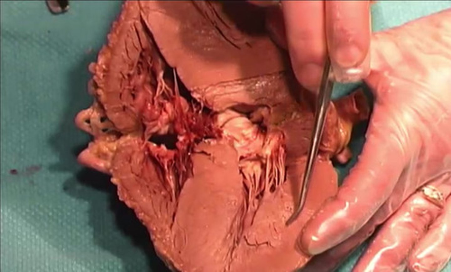 <p>Which portion of the heart is this being shown by the pointer?</p><p>left atrium</p><p>right ventricle</p><p>left ventricle</p><p>right atrium</p>