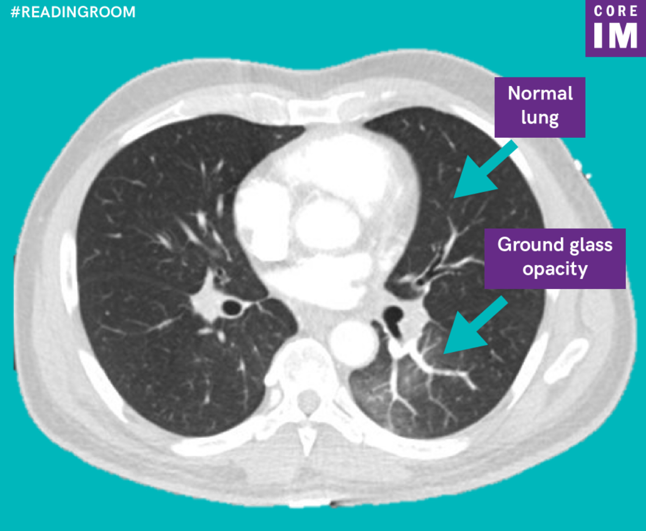 <p>HRCT</p><ol><li><p>Bronchial dilatation</p></li><li><p>Wall thickening with GGO ground glass opacity</p></li></ol>
