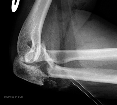 <p>Loss of full extension, scar tissue, non-union.</p>