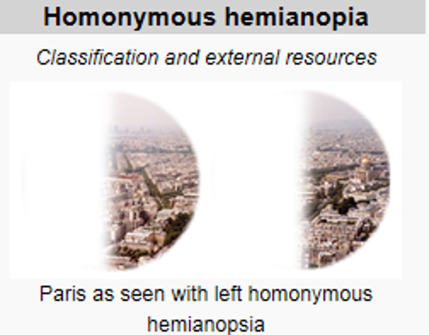 <p>loss of half of the field of view on the same side in both eyes</p>