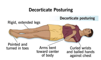 <p>UE flexion, LE extension</p>