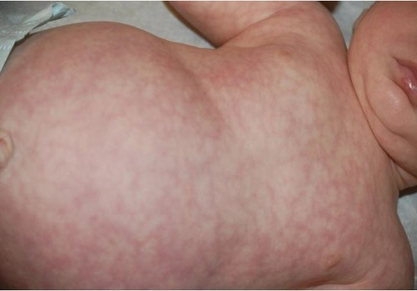 <p>transient mottling in the trunk and extremities</p><p>in response to cooler room temperatures in babies</p>
