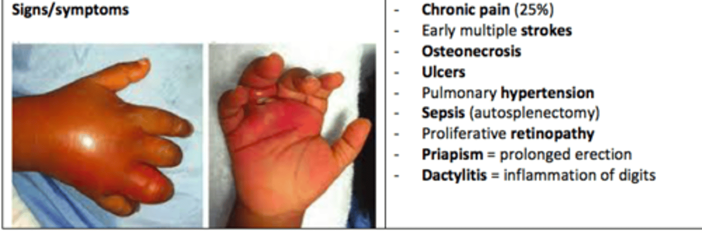 <p>Chronic pain (25%)</p><p>Early multiple strokes</p><p>Osteonecrosis</p><p>Ulcers</p><p>Pulmonary hypertension</p><p>Sepsis (autosplenectomy)</p><p>Proliferative retinopathy</p><p>Priapism</p><p>Dactylitis</p>