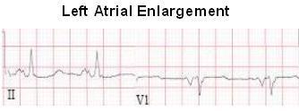 <p>LAE diagnosis:</p>
