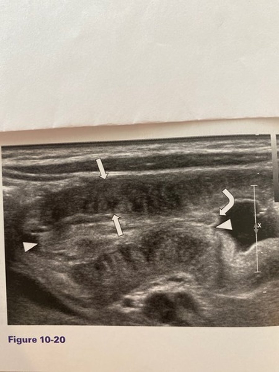<p>What is the most common age range at which the abnormality occurs in Figure 10-20?</p><p>a. 5 to 10 years of age</p><p>b. 1 to 4 weeks of age</p><p>c. 3 months to 3 years of age</p><p>d. 2 to 6 weeks of age</p>