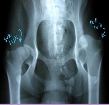 <p><span style="background-color: transparent;"><strong><span>Hip Luxation Pathophysiology</span></strong></span></p>