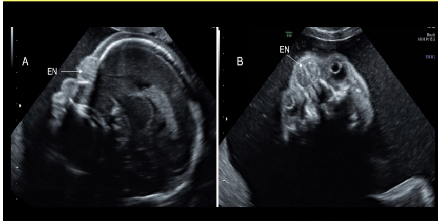 <p>hypertelorism is most commonly caused by </p><p>a) spina bifida</p><p>b) posterior encephalocele</p><p>c) anterior encephalocele</p><p>d) cystic hygroma </p>