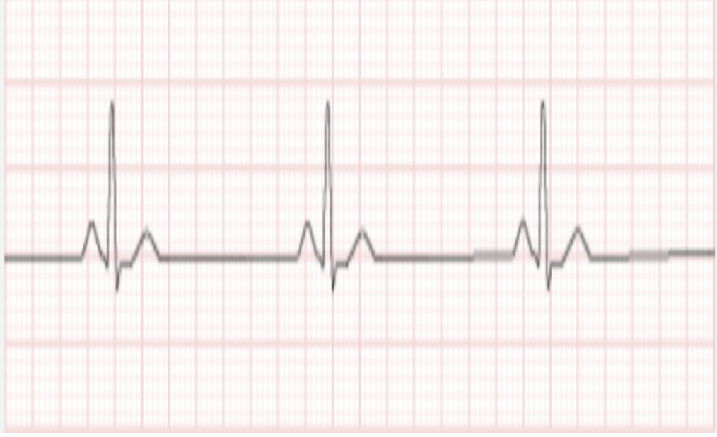 <p>Rate: &lt;60 bpm</p><p>everything else is normal - common in well conditioned poeple&nbsp;</p><p>Can be nromal or systemic&nbsp;</p>