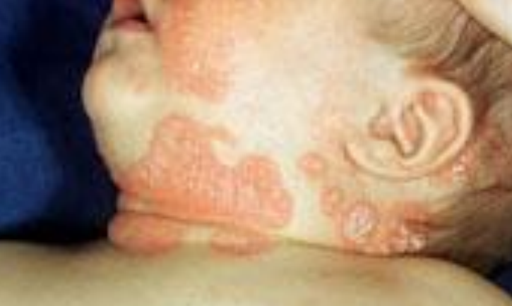 <p>Identify the descriptive term for this lesion</p>