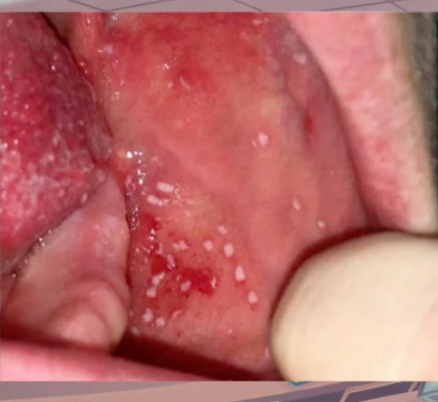 <p>what are these spots, caused by PARAMYXOVIRUS (<strong>measles</strong>)</p>