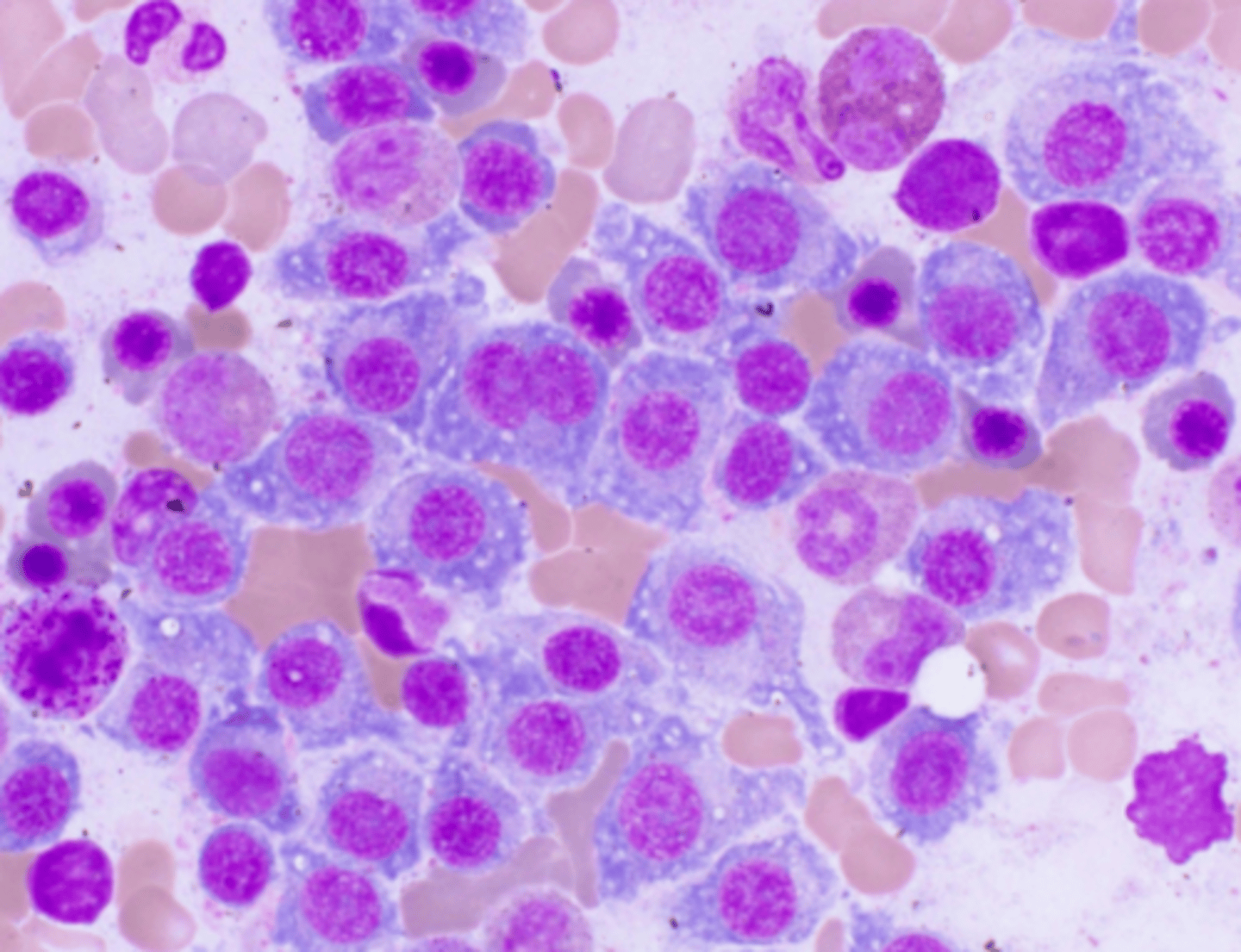 <p>Type "Skip"</p><p>Just showing a pic of BM touch preparation showing mature and immature plasma cells, one of which is binucleate</p>