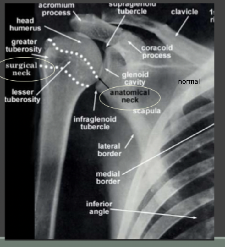 <p>Anatomical location of Proximal humerus fracture (normal xray)</p>