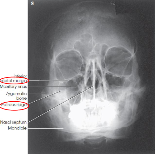 <ul><li><p>facial bones with less axial angulation than Waters method</p></li><li><p>petrous ridges projected just below the inferior border of the orbits at a level midway through the maxillary sinuses</p><ul><li><p>orbital floor seen perpendicular to the IR and parallel to the CR<br>demonstrates inferior displacement of the orbital floor</p></li><li><p>opacified maxillary sinus</p></li></ul></li></ul><p></p>