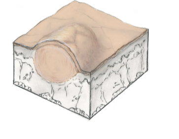 Papule 