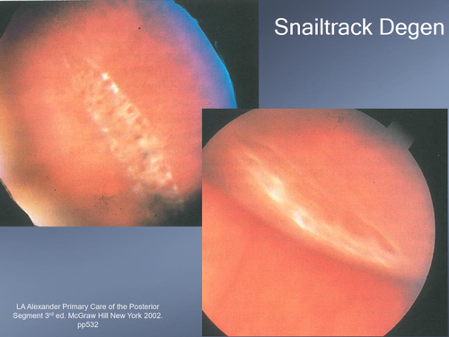 <p>similar to lattice, but different appearance d/t microglial cells containing lipoprotein</p>