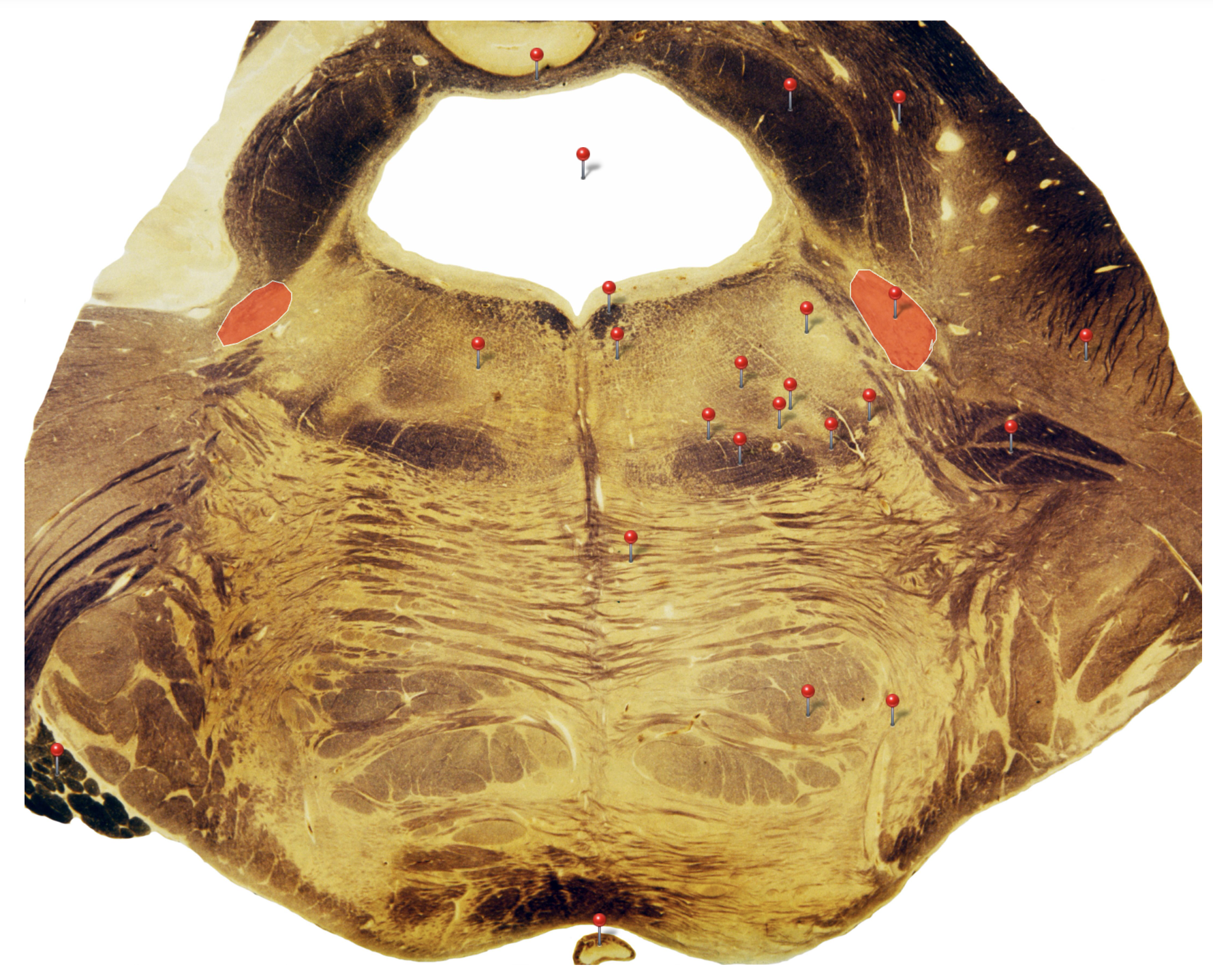 <p>Spinal Principle Nucleus</p>