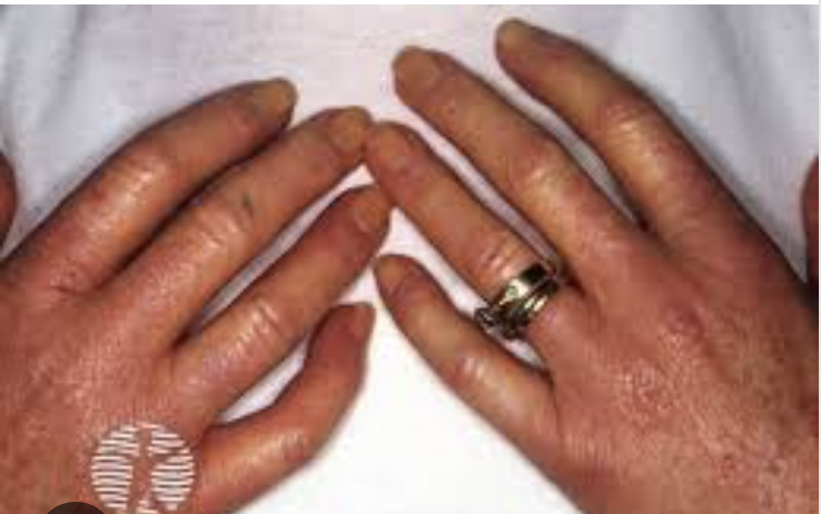 <p>Tightening and thickening of fingers and toes</p>