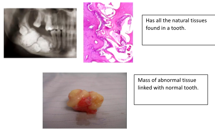 <p>- Mandible > Maxilla</p><p>- Premolar/Molar Regions</p><p>- Ages 10 to 25</p><p>- Often a missing tooth in the arch - tooth fuses to odontome</p><p>- A fused mass of haphazardly arranged tooth tissues but normal morphogenetic relations are preserved</p>