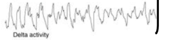 <p>what sleep stage is this EEG recording?</p>