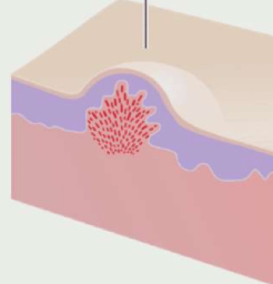 <p>¿lesión?</p><p>¿primaria o secundaria?</p>
