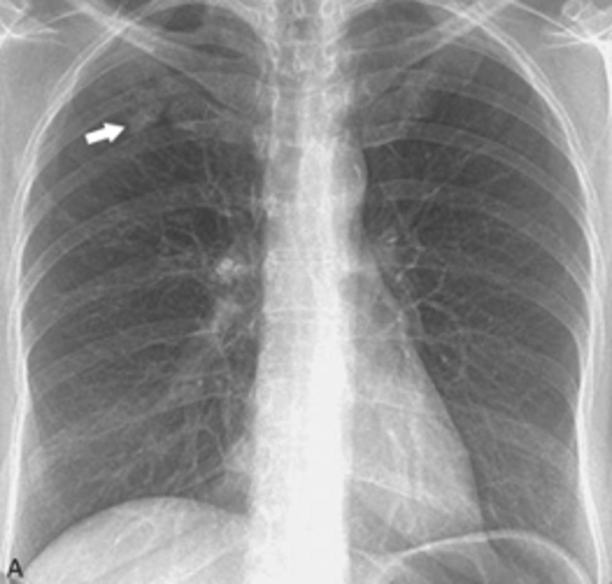 <p>are the most common type of lung CA and usually occur peripherally.</p>