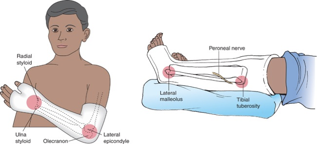 <p>leg cast: monitor for peroneal nerve damage which can cause foot drop </p>